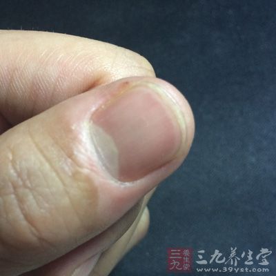指甲出現白點(diǎn)或絮狀白斑